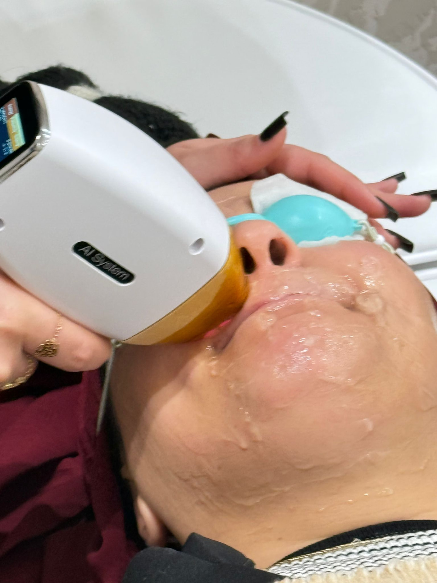 Nahaufnahme der Behandlung mit Alix Lasers AI System