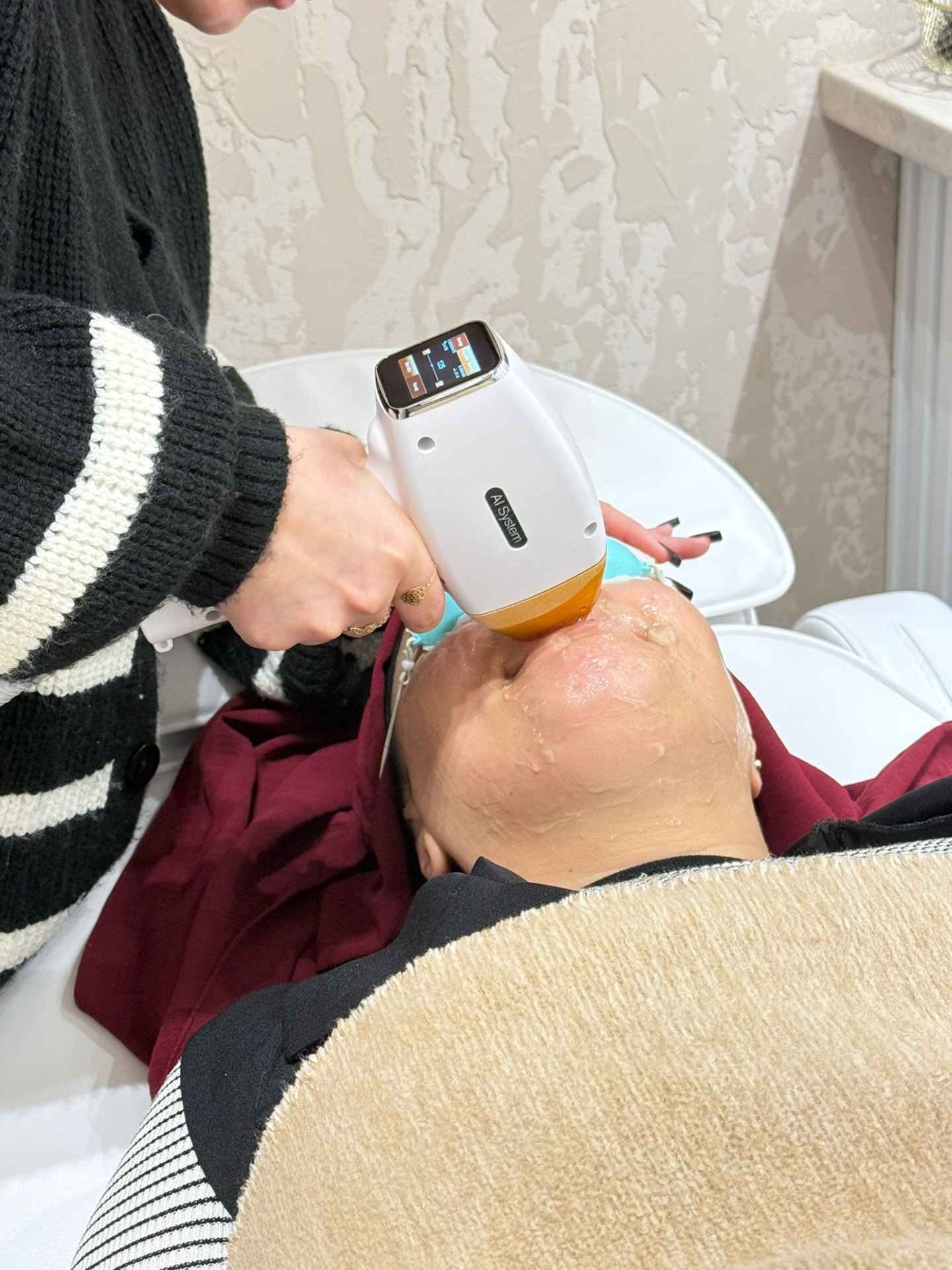Behandlung im Gesicht mit Alix Lasers AI System Handstück